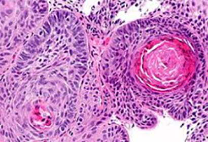 Morphological of esophageal squamous carcinoma cells