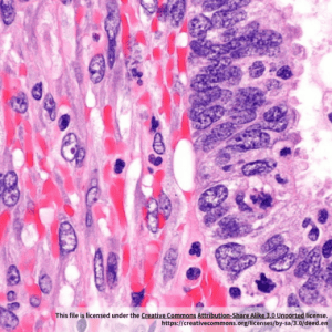 Human Lung Adenocarcinoma Carcinoma Associated Fibroblasts