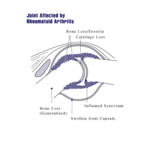 Immortalized Human Fibroblast-Like Synoviocyte Rheumatoid Arthritis