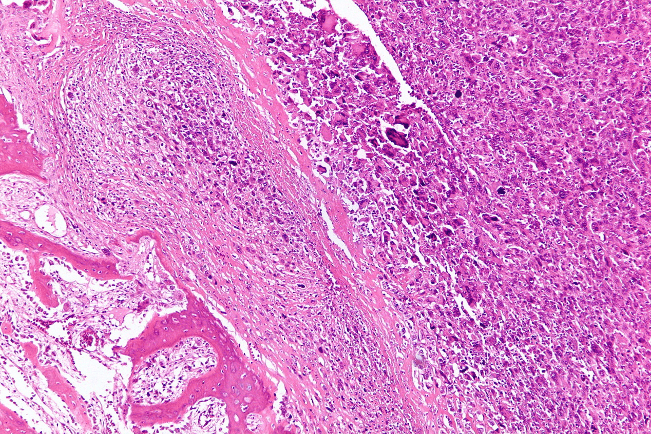 Osteosarcoma pathological section