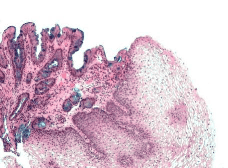 Human Esophageal Epithelial Cells and Esophageal Diseases